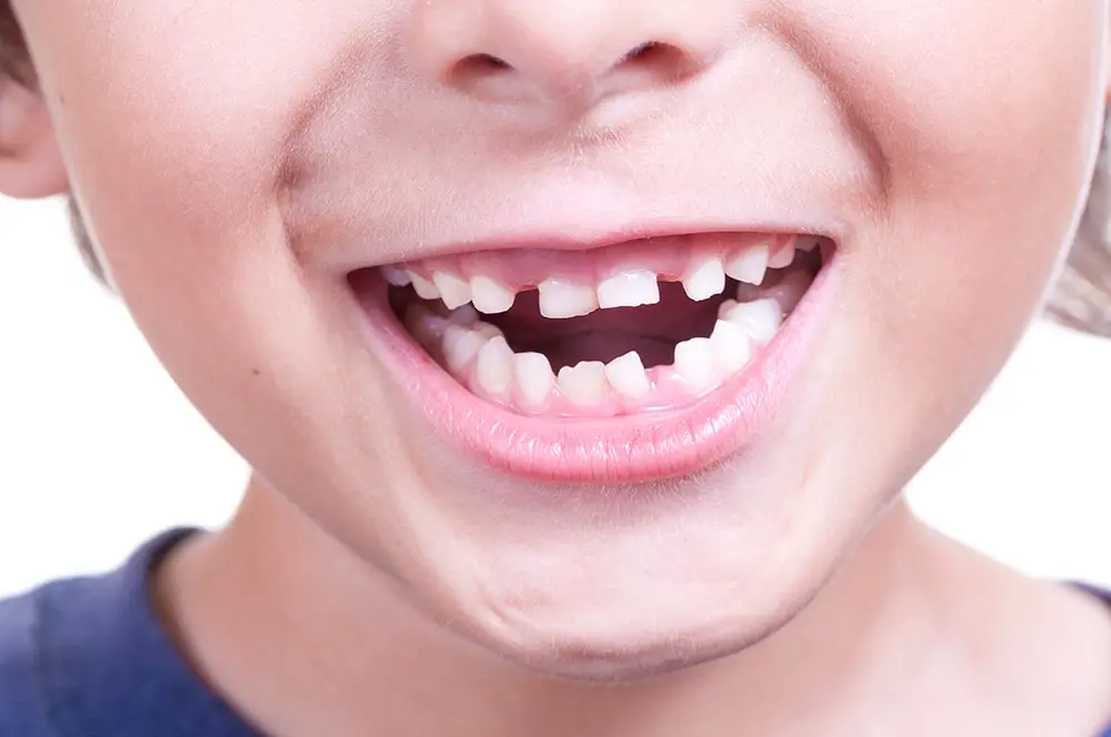 boy smiling with baby teeth